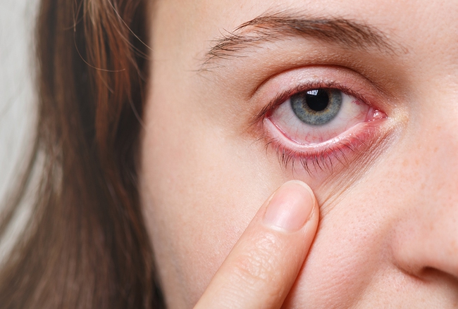 Mí mắt bị sưng sau khi ngủ dậy là dấu hiệu cơ thể đang cố gắng cảnh báo những vấn đề sức khỏe này - Ảnh 2.