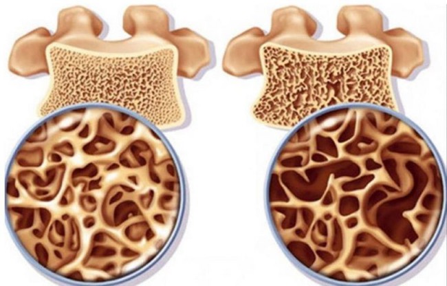 Sau tuổi 30, phụ nữ cần thường xuyên ăn 7 "món" này nếu không muốn mất xương dần dần, khuyến cáo 2 việc cần tránh, một việc phải làm để xương khỏe, người dẻo dai - Ảnh 4.