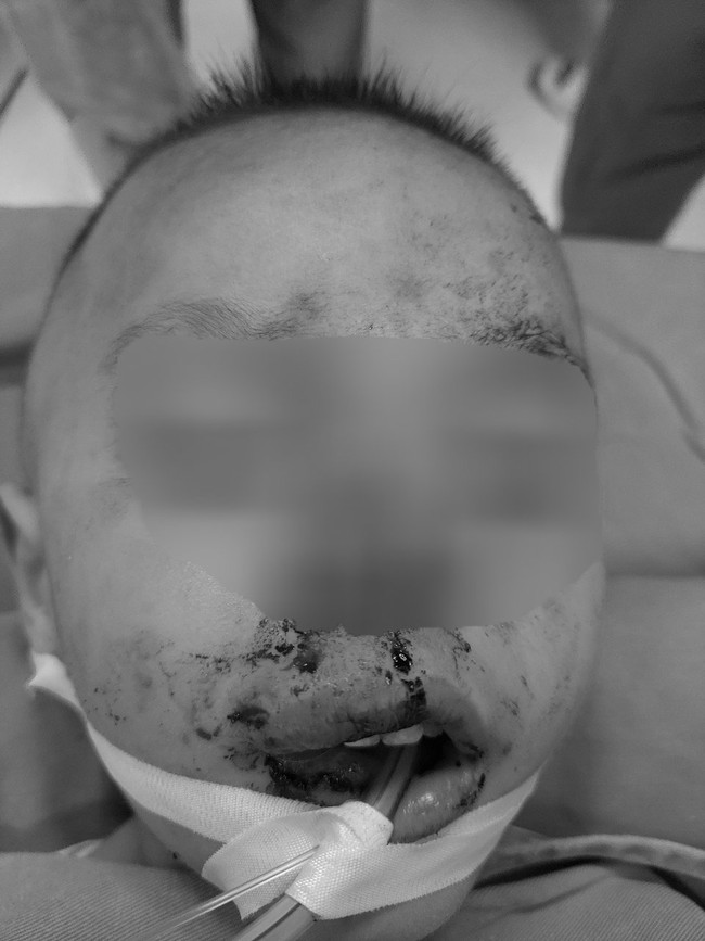 A 2-year-old boy has a wound on his face due to being bitten by a neighbor's dog - Photo 1.