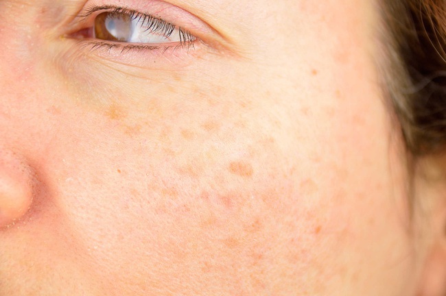 When the skin begins to appear melasma, this is what you should do immediately - Photo 1.