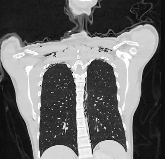 Rare: A 20-year-old man with lung damage due to 