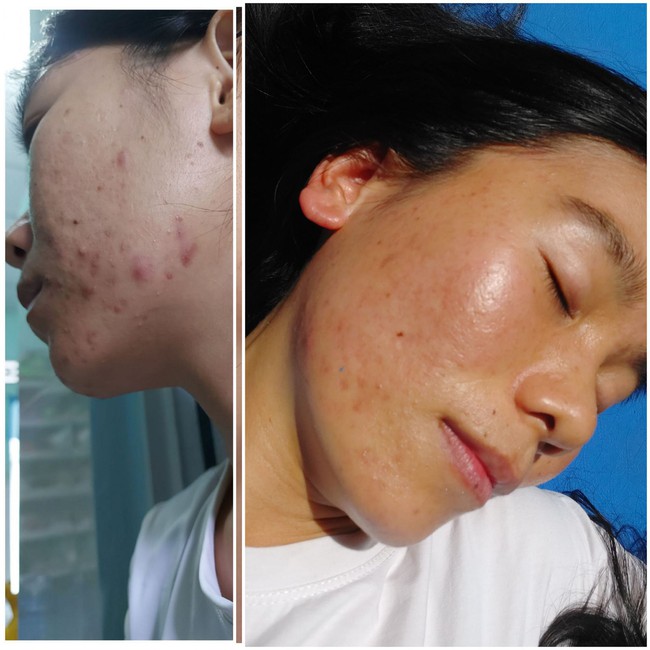 Face acne 10 years and many diseases, the woman 