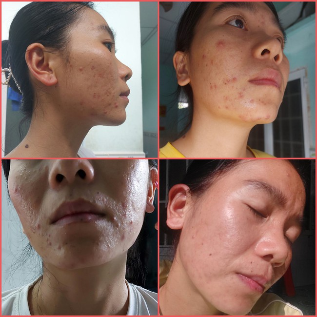 Face acne 10 years and many diseases, the woman 