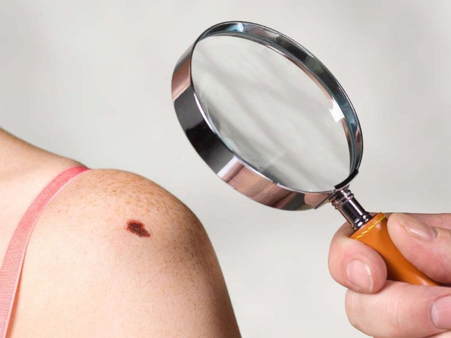 7 warning signs of skin cancer people should not ignore - Photo 1.