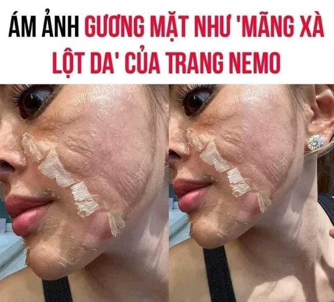 Từ vụ Trang Nemo hóa &quot;mãng xà lột da&quot;: 3 nguyên tắc peel da chị em cần nhớ - Ảnh 1.