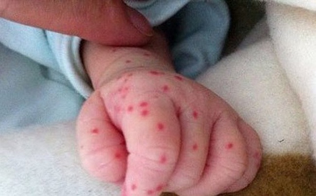 Trẻ bị sốt xuất huyết: Áp dụng một trong 4 cách sau sẽ nhanh khỏi bệnh tại nhà - Ảnh 5.