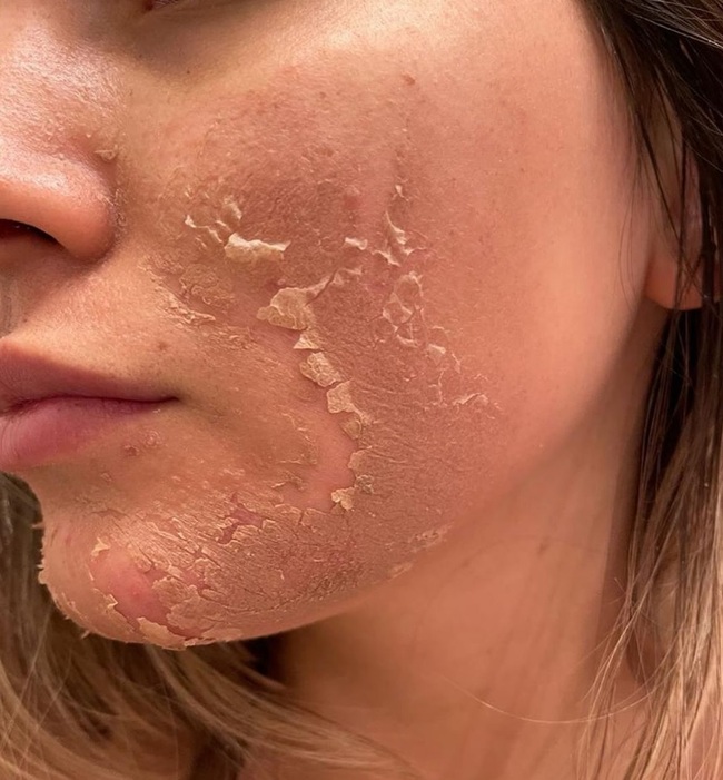 Chuyên gia chỉ ra 3 bước thiết yếu cần làm ngay để da đẹp và ngăn ngừa nám  - Ảnh 2.