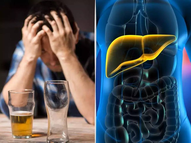 Dấu hiệu cảnh báo sớm cho thấy gan đang bị tổn thương do uống nhiều rượu bia - Ảnh 2.