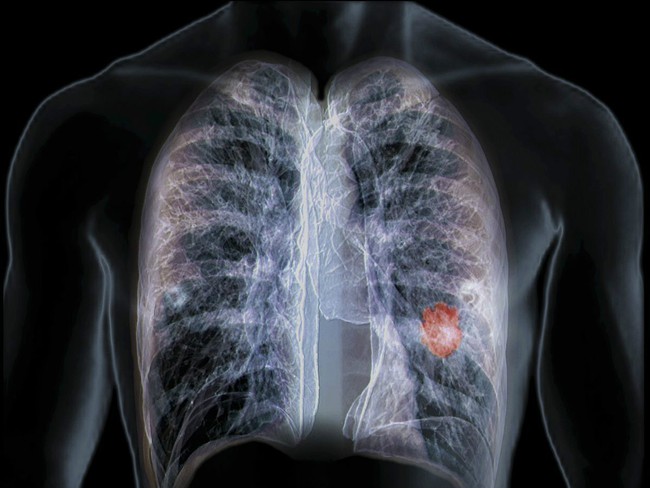 Người phụ nữ 45 tuổi được chẩn đoán mắc ung thư phổi giai đoạn cuối vì tiếp xúc với 2 thứ trong thời gian dài - Ảnh 1.