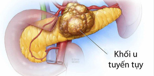 Triệu chứng ung thư tuyến tụy giai đoạn đầu - Ảnh 3.