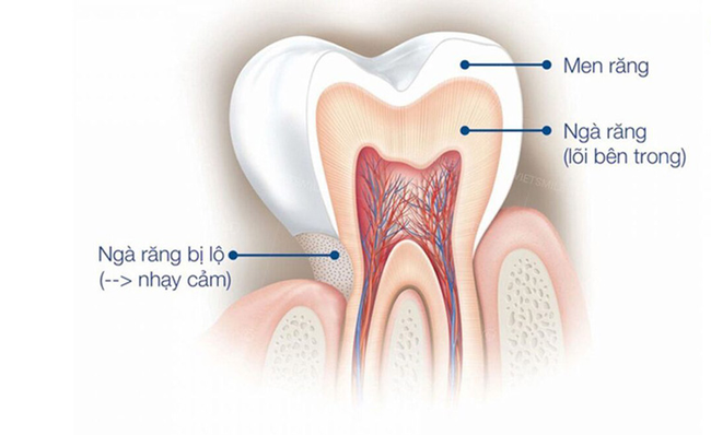 Răng ê buốt là do đâu: Lời cảnh tỉnh của bác sĩ nha khoa khiến bạn phải xem lại thói quen làm sạch răng mỗi ngày - Ảnh 2. Răng ê buốt là do đâu: Lời cảnh tỉnh của bác sĩ nha khoa khiến bạn phải xem lại thói quen làm sạch răng mỗi ngày - Ảnh 2.