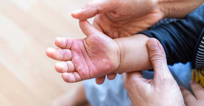 B&aacute;c sĩ hướng dẫn c&aacute;ch sơ cứu đ&uacute;ng khi trẻ bị bỏng - Ảnh 1.