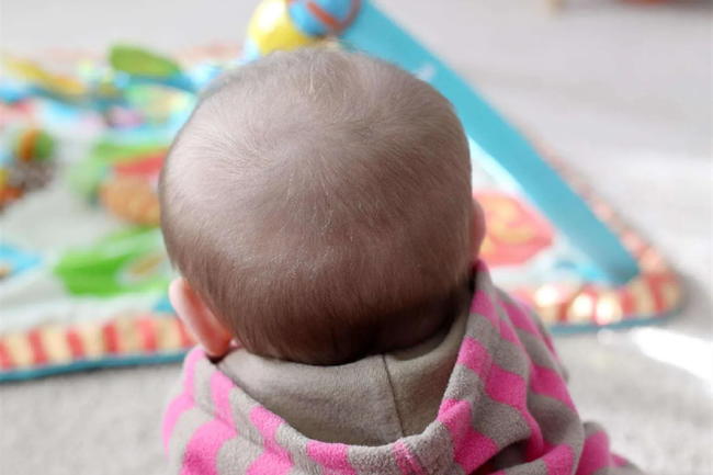 6 trạng thái mọc tóc chứng tỏ trẻ phát triển không bình thường, có thể suy dinh dưỡng - Ảnh 2.