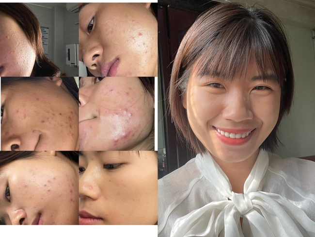 giảm mỡ bụng - Ảnh 5. giảm mỡ bụng - Ảnh 5.