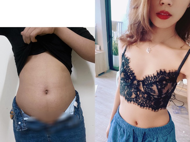 giảm mỡ bụng - Ảnh 3. giảm mỡ bụng - Ảnh 3.