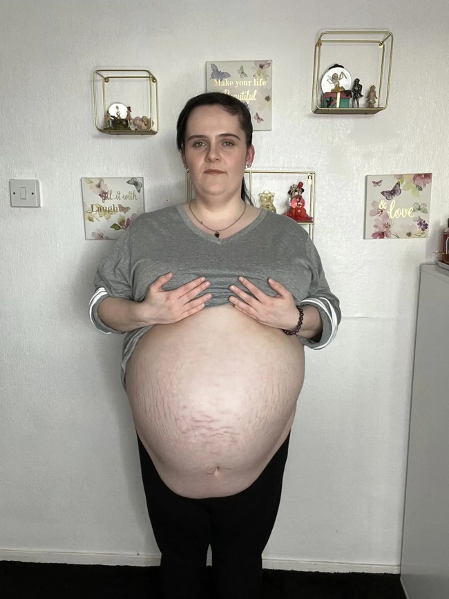 Tưởng mang thai, người phụ nữ không ngờ mình bị u nang buồng trứng nặng 16kg - Ảnh 1.