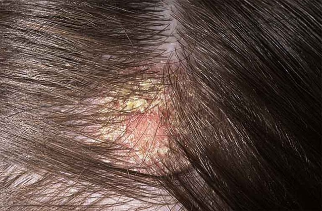 Có 1 dấu hiệu ung thư da đầu rất giống với gàu, ai cũng chủ quan bỏ qua, tới lúc bệnh nặng rất khó chữa - Ảnh 1.