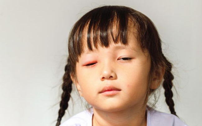 Bệnh đau mắt đỏ lây nhanh ở trẻ dưới 5 tuổi - Ảnh 1.