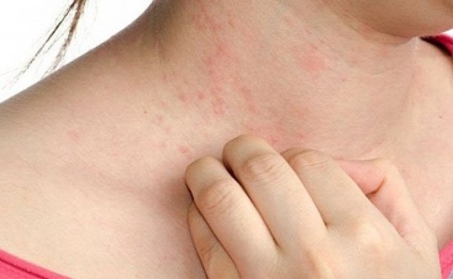 BS da liễu khuyến cáo cách phòng ngừa 6 bệnh ngoài da thường gặp trong mùa hè - Ảnh 2.