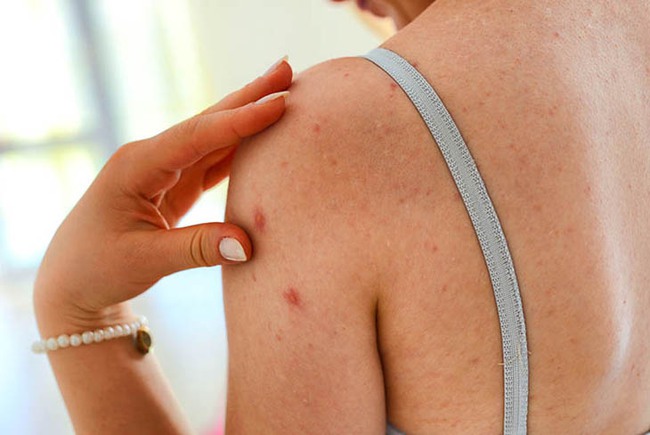 BS da liễu khuyến cáo cách phòng ngừa 6 bệnh ngoài da thường gặp trong mùa hè - Ảnh 3.