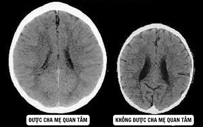 Đoán được tương lai của đứa trẻ qua bức ảnh chụp về não bộ của 2 em bé - Ảnh 1.