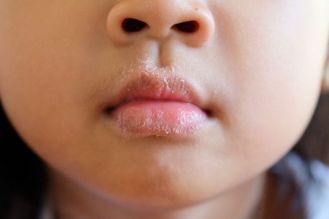 Cha mẹ hãy chú ý tới việc con cái hay liếm môi, có thể trẻ mắc căn bệnh này - Ảnh 1.