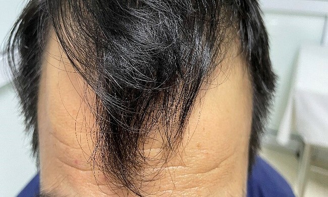 Nam thanh niên 31 tuổi nhập viện vì rụng tóc, tiêu chảy mất kiểm soát, phát hiện nguyên nhân do ăn thiếu 1 thứ mỗi ngày - Ảnh 2.