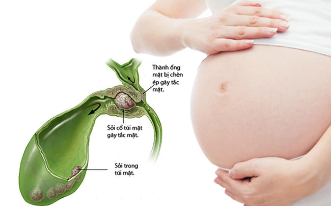 Nguyên nhân khiến sỏi mật dễ bị bỏ qua trong thai kỳ - Ảnh 1.