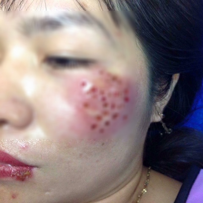 Chữa nám tại spa, người phụ nữ U40 nhận lấy gương mặt rỗ như tổ ong, dịch chảy không ngừng - Ảnh 1.