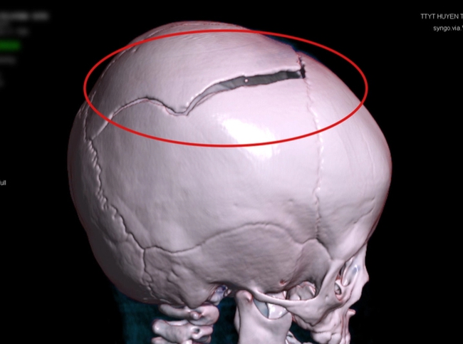 Sập cánh cổng, bé 15 tháng tuổi chấn thương sọ não - Ảnh 1.