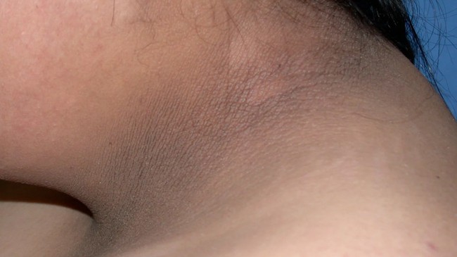 acanthosis-nigricans-body1-17224098529141980751605-1722411596289-17224115965121609768214-1722437302527-1722437302692838174440.jpg