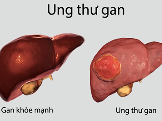 Cơn đau dạ dày có đặc điểm này cảnh báo ung thư: NHS khuyên mọi người đi khám ngay để tránh 7 bệnh "tử thần" - Ảnh 5.