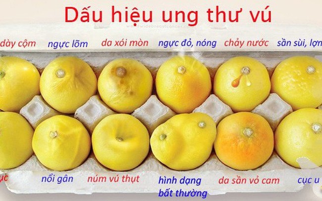 19 tuổi bàng hoàng nhận tin ung thư vú dù không đau, không ngứa, BS nói chi tiết này rất quan trọng khi tắm thường bị bỏ qua - Ảnh 6.