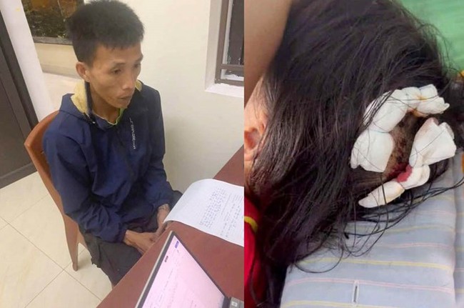 Sức khỏe của bé gái bị cha dượng dùng búa đánh vào đầu hiện ra sao? - Ảnh 2. Sức khỏe của bé gái bị cha dượng dùng búa đánh vào đầu hiện ra sao? - Ảnh 2.