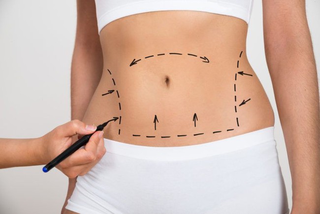 Hút mỡ Vaser Lipo: Giải pháp không phẫu thuật nhưng vẫn cần thận trọng - Ảnh 1. Hút mỡ Vaser Lipo: Giải pháp không phẫu thuật nhưng vẫn cần thận trọng - Ảnh 1.