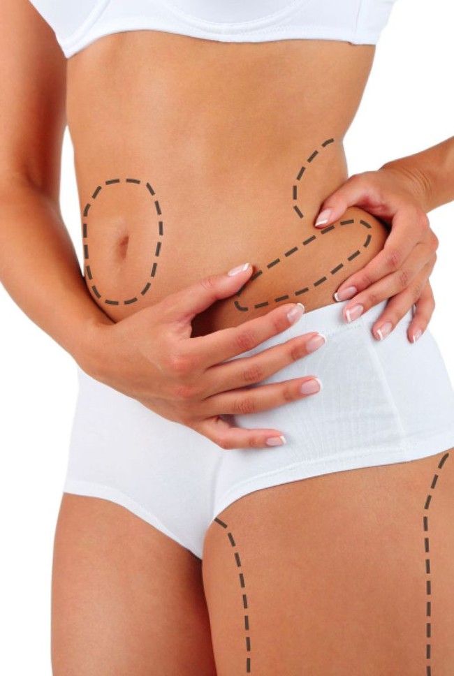 Hút mỡ Vaser Lipo: Giải pháp không phẫu thuật nhưng vẫn cần thận trọng - Ảnh 2. Hút mỡ Vaser Lipo: Giải pháp không phẫu thuật nhưng vẫn cần thận trọng - Ảnh 2.