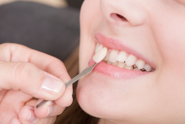 Cách chăm sóc răng sau khi làm veneer: Bí quyết giữ nụ cười trắng sáng lâu dài - Ảnh 1.