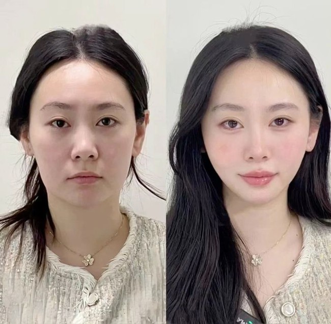 Soi kỹ công nghệ chỉnh nha Meaw – vì sao được săn đón? - Ảnh 3. Soi kỹ công nghệ chỉnh nha Meaw – vì sao được săn đón? - Ảnh 3.