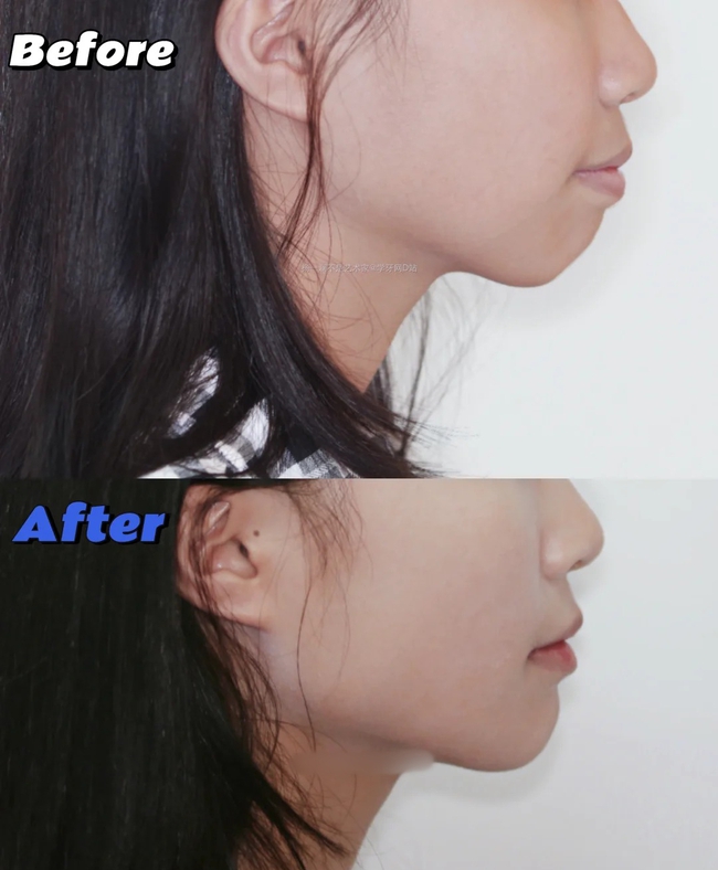 Soi kỹ công nghệ chỉnh nha Meaw – vì sao được săn đón? - Ảnh 1. Soi kỹ công nghệ chỉnh nha Meaw – vì sao được săn đón? - Ảnh 1.