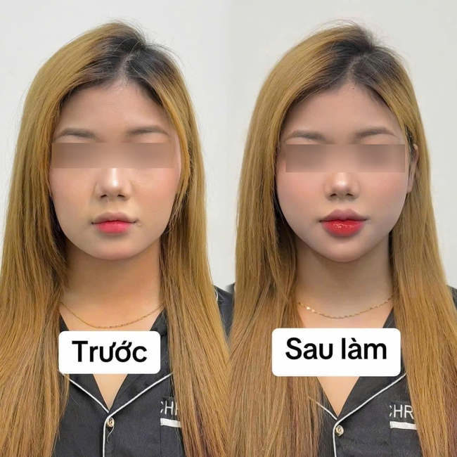 tiem-can-chinh-full-face-gia-bao-nhieu7-17407188857551954350783.jpg