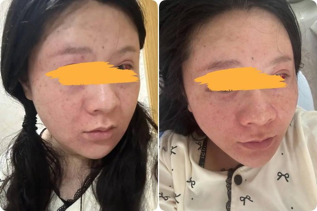 Mẹ bầu sinh con, bất ngờ gặp “tai nạn đỏ mặt”: Dùng sức sai cách khiến toàn bộ khuôn mặt sưng đỏ và vỡ mạch máu - Ảnh 1. Mẹ bầu sinh con, bất ngờ gặp “tai nạn đỏ mặt”: Dùng sức sai cách khiến toàn bộ khuôn mặt sưng đỏ và vỡ mạch máu - Ảnh 1.