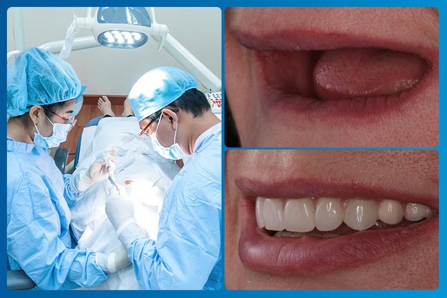 Khuôn mặt lệch, nếp nhăn sớm có thể bắt nguồn từ việc mất răng – Đừng xem nhẹ! - Ảnh 3. Khuôn mặt lệch, nếp nhăn sớm có thể bắt nguồn từ việc mất răng – Đừng xem nhẹ! - Ảnh 3.