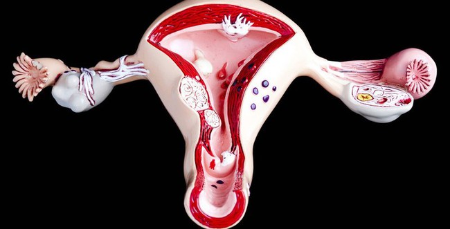 Coi thường kinh nguyệt không đều ở giai đoạn tiền mãn kinh, người phụ nữ bị lạc nội mạc tử cung nghiêm trọng - Ảnh 2. Coi thường kinh nguyệt không đều ở giai đoạn tiền mãn kinh, người phụ nữ bị lạc nội mạc tử cung nghiêm trọng - Ảnh 2.