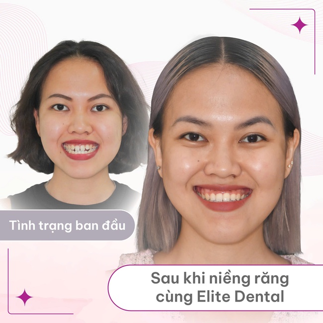 Kiên nhẫn 5 năm 4 tháng niềng răng, cô gái khiến nhiều người kinh ngạc ngưỡng mộ vì thay đổi khuôn mặt không cần phẫu thuật thẩm mỹ - Ảnh 2. Kiên nhẫn 5 năm 4 tháng niềng răng, cô gái khiến nhiều người kinh ngạc ngưỡng mộ vì thay đổi khuôn mặt không cần phẫu thuật thẩm mỹ - Ảnh 2.