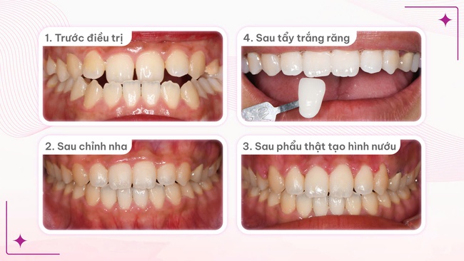 Kiên nhẫn 5 năm 4 tháng niềng răng, cô gái khiến nhiều người kinh ngạc ngưỡng mộ vì thay đổi khuôn mặt không cần phẫu thuật thẩm mỹ - Ảnh 6. Kiên nhẫn 5 năm 4 tháng niềng răng, cô gái khiến nhiều người kinh ngạc ngưỡng mộ vì thay đổi khuôn mặt không cần phẫu thuật thẩm mỹ - Ảnh 6.