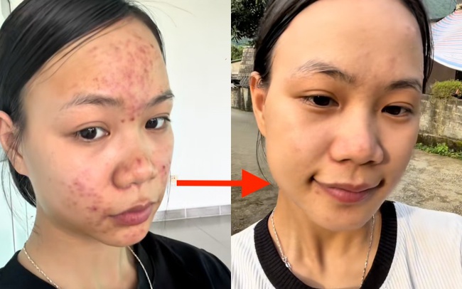 Da chi chít mụn do 5 năm rửa mặt sai cách, cô nàng chữa lành làn da bằng loại hạt mà mọi người vứt bỏ - Ảnh 10. Da chi chít mụn do 5 năm rửa mặt sai cách, cô nàng chữa lành làn da bằng loại hạt mà mọi người vứt bỏ - Ảnh 10.