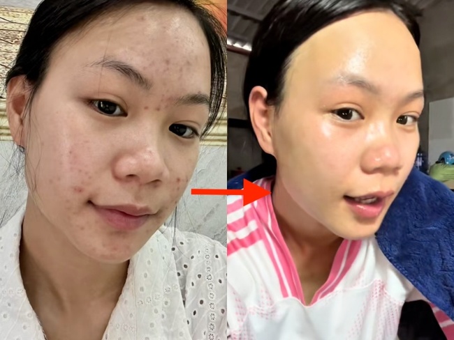 Da chi chít mụn do 5 năm rửa mặt sai cách, cô nàng chữa lành làn da bằng loại hạt mà mọi người vứt bỏ - Ảnh 6. Da chi chít mụn do 5 năm rửa mặt sai cách, cô nàng chữa lành làn da bằng loại hạt mà mọi người vứt bỏ - Ảnh 6.