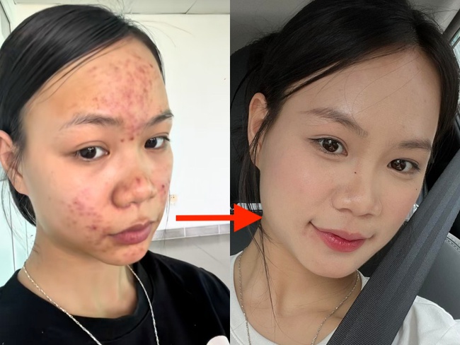 Da chi chít mụn do 5 năm rửa mặt sai cách, cô nàng chữa lành làn da bằng loại hạt mà mọi người vứt bỏ - Ảnh 11. Da chi chít mụn do 5 năm rửa mặt sai cách, cô nàng chữa lành làn da bằng loại hạt mà mọi người vứt bỏ - Ảnh 11.
