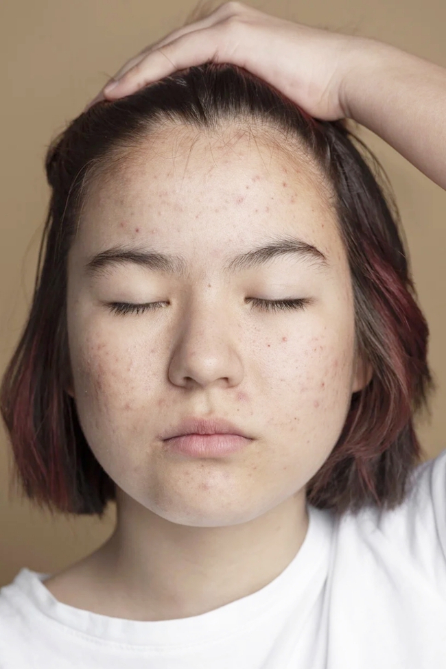 Hướng dẫn dùng Retinol đúng cách, da bị nổi mụn khi dùng có phải là điều bình thường? - Ảnh 1. Hướng dẫn dùng Retinol đúng cách, da bị nổi mụn khi dùng có phải là điều bình thường? - Ảnh 1.