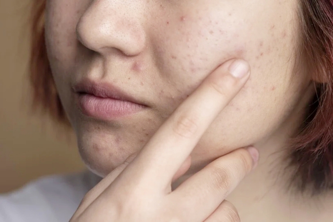 Hướng dẫn dùng Retinol đúng cách, da bị nổi mụn khi dùng có phải là điều bình thường? - Ảnh 2. Hướng dẫn dùng Retinol đúng cách, da bị nổi mụn khi dùng có phải là điều bình thường? - Ảnh 2.